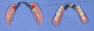 Bridges/Partials (Removable)