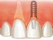 Single Tooth Replacement (Crowns)