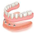Implant Dentures (Removable)