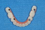 Implant Dentures (Non-Removable)