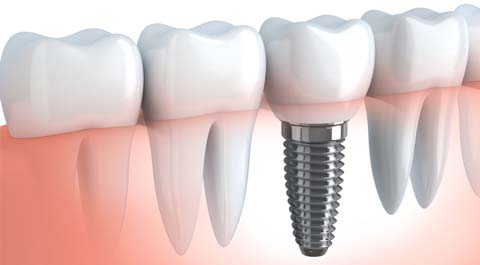 Dental Implants