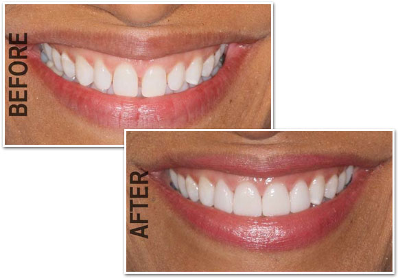 Porcelain Veneers