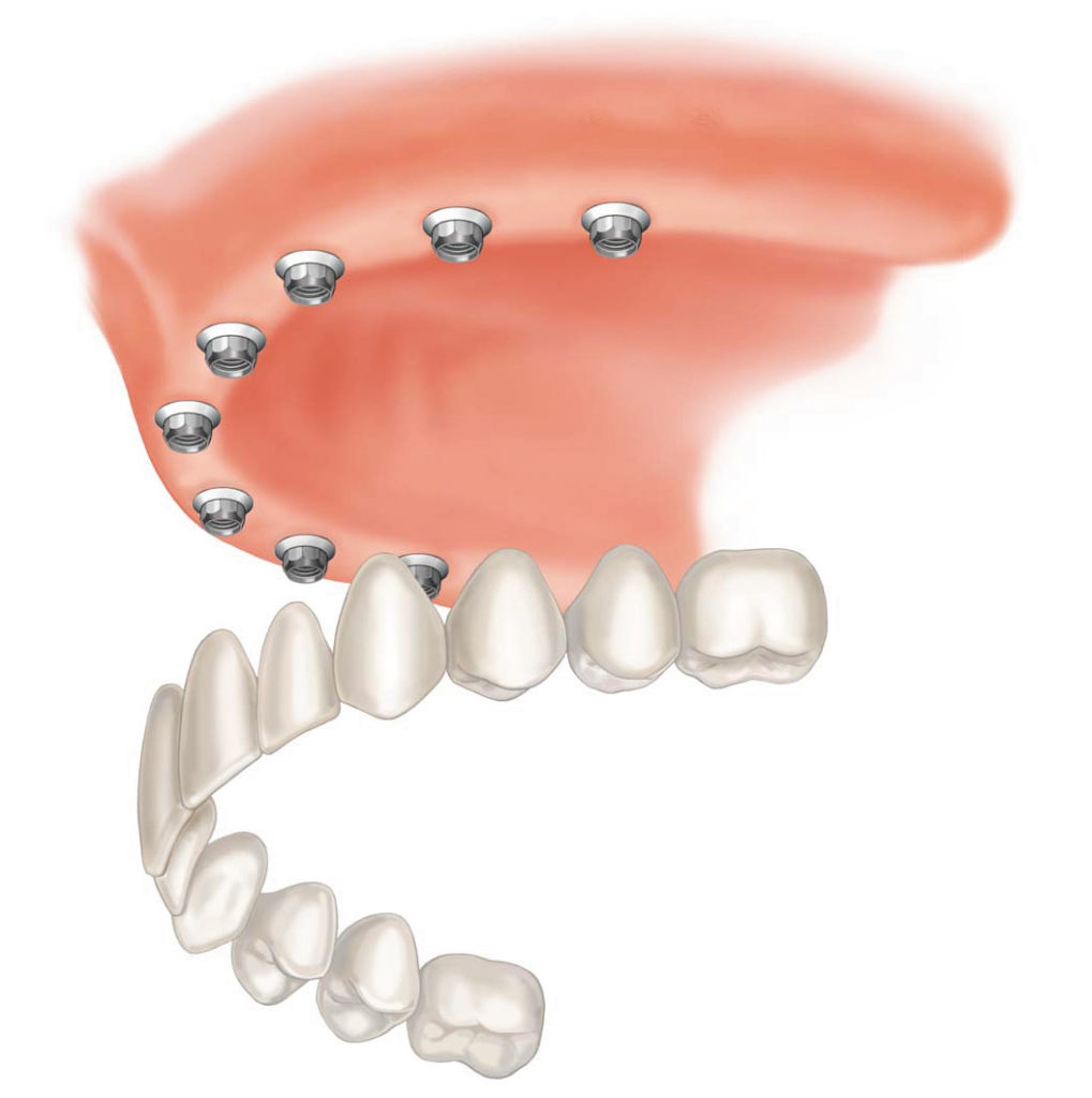 F Implant supported bridge