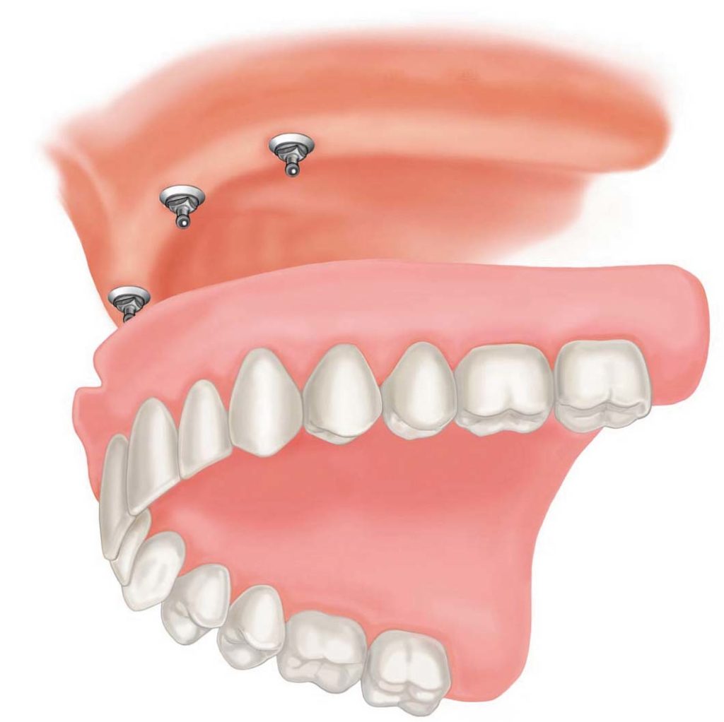 F-Implant-supported-overdenture