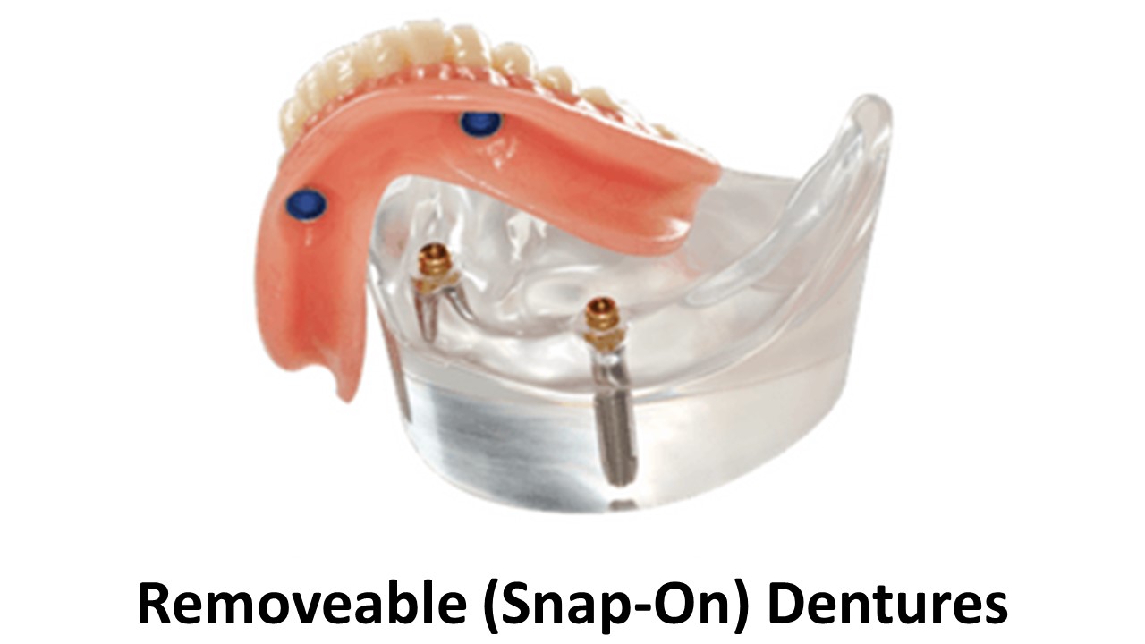 SnapOn Denture