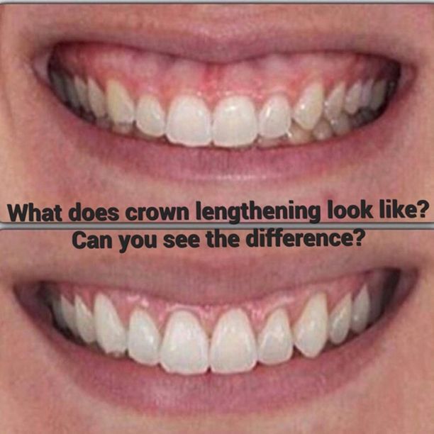 Crown Lengthening