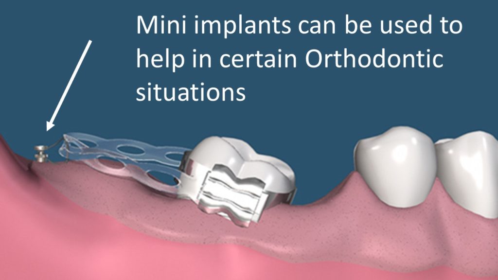 Ortho implant