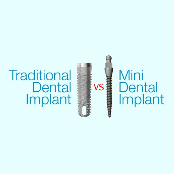 Min vs Reg implant