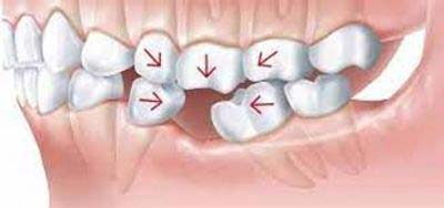 Shifting Back teeth