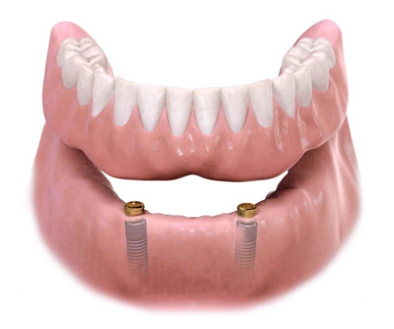 REMOVEABLE vs. FIXED IMPLANT DENTURE OPTIONS