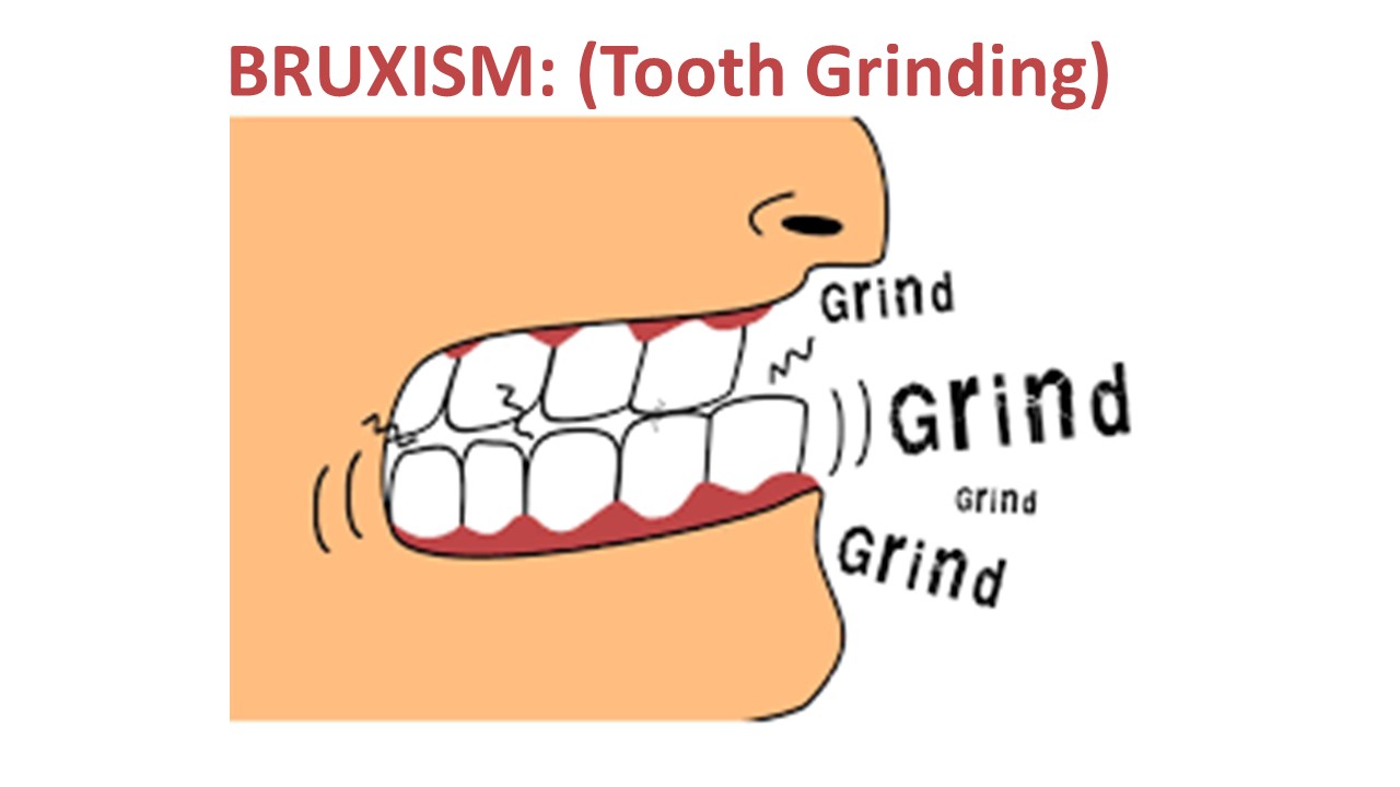 ALL ABOUT BRUXISM (TOOTH GRINDING) Dallas Dental Implant Center