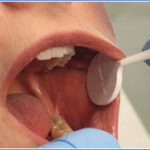 Oral cancer, inner lip and cheek area