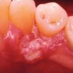 Oral cancer on gums, red bumpy lesion on gum around tooth