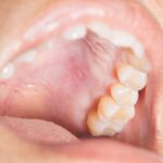 Oral cancer lesion on roof of mouth