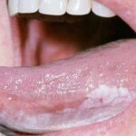 Tongue cancer, white patch on bottom and side of tongue